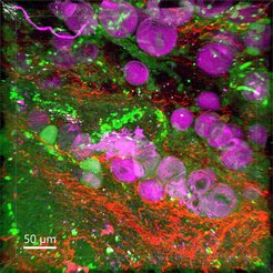 Die Abbildung zeigt den Brusttumor einer Maus, aufgenommen mit einem sogenannten Zwei-Photonen-Mikroskop. Tumorzellen sind in grün erkennbar, Kollagenfasern in rot und Fettablagerungen in magenta. Das im Rahmen des FAIR CHARM-Projekts gebaute Short-Wave-Infrared Microscope (SWIM) wird es ermöglichen, solche Strukturen in einer bisher nicht gekannten Gewebetiefe sichtbar zu machen.