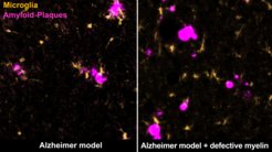 Certain immune cells, microglia (yellow), remove amyloid plaques (magenta) in the brain of the Alzheimer mouse (left). Degenerating myelin distracts them from doing so (right).