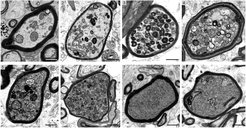 Die Bilderserie zeigt elektronenmikroskopische Aufnahmen einzelner Nervenfasern in MS Hirnbiopsien im Querschnitt. Zu sehen sind mit Myelin (schwarze Ringe) ummantelte Axone, die von 1 bis 8 zunehmend starke Schädigungen aufweisen. Das Spektrum reicht dabei von der Anreicherung einzelner Zellbestandteile in sonst noch hellen, intakten Axonen (1) bis hin zur fortgeschrittenen Degeneration in dunklen irreversibel geschädigten Axonen (8).