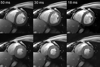 <span>The Basic Paper: Real-Time MRI at a Resolution of 20 ms</span>