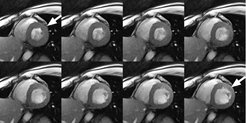 Real-time MRI of the heart (short-axis view) with a measurement time of 33 ms per image and a spatial resolution of 1.5 mm (section thickness 8 mm). The eight successive images show the movement of the heart muscle of a healthy subject for a period of 264 ms during a single heartbeat. The images range from the systolic phase (top left: thickening and contraction of the left-ventricular myocardial wall) to the diastolic phase (bottom right: relaxation and expansion). The bright signal in the heart chambers is the blood.